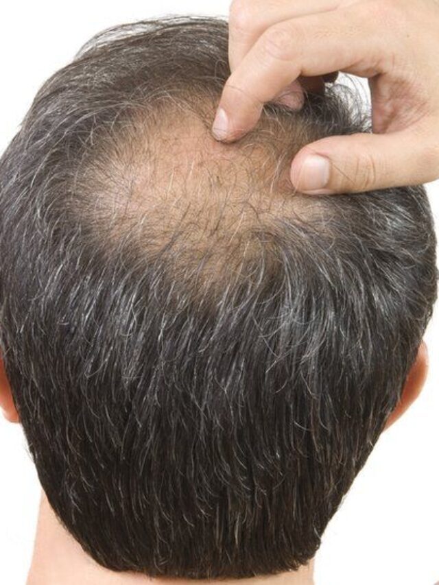 How To Reverse Baldness In Male