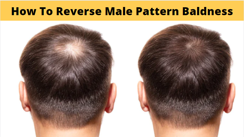How To Reverse Male Pattern Baldness
