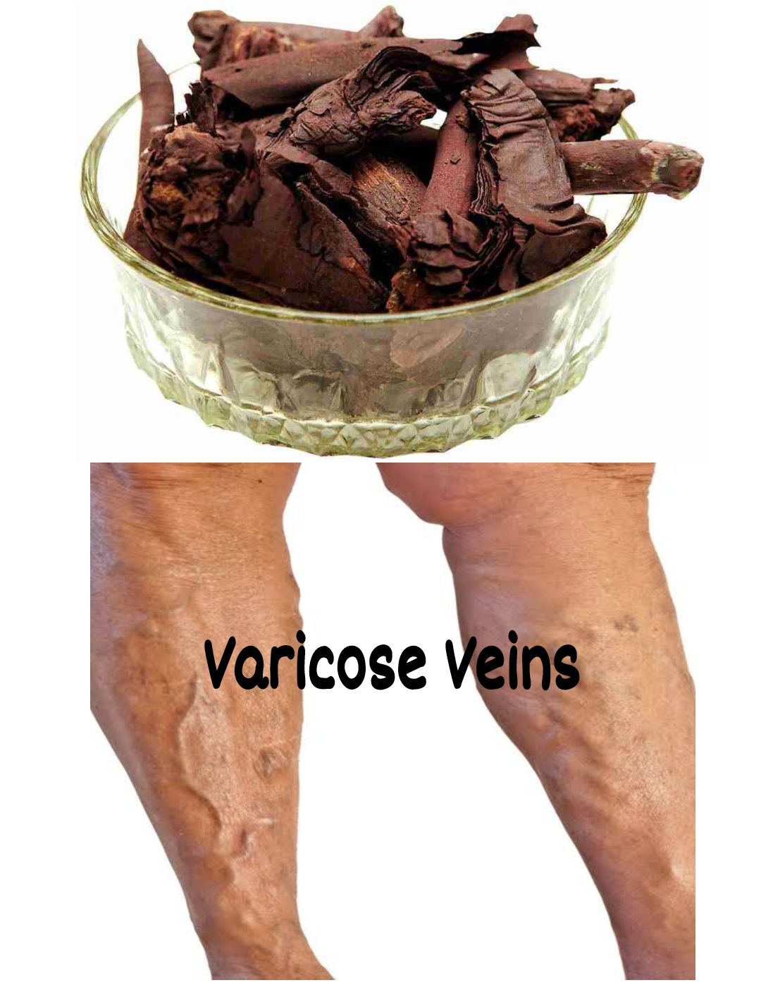 How To Use Ratanjot For Varicose Veins Athletes