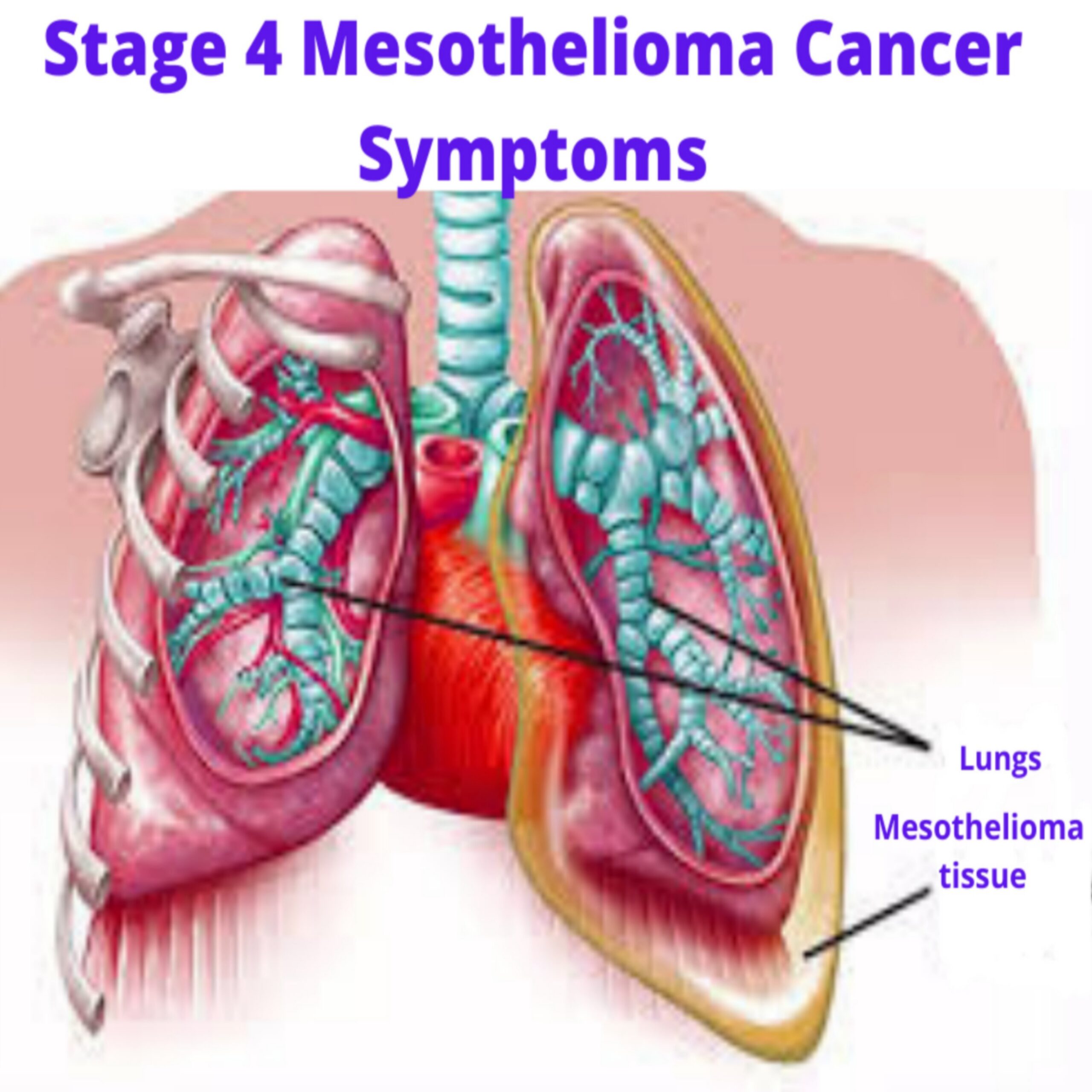 Stage 4 Mesothelioma Cancer Symptoms | Mesothelioma