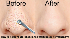 How To Remove Blackheads And Whiteheads Permanently