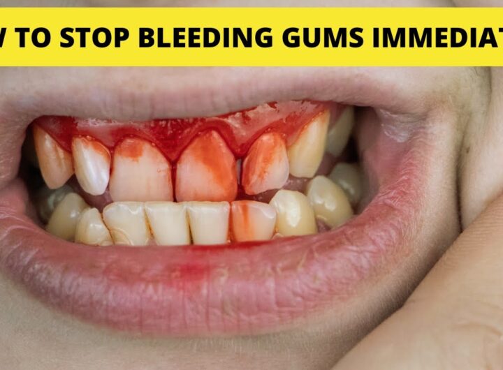 How To Stop Gum Bleeding Immediately Home Remedy