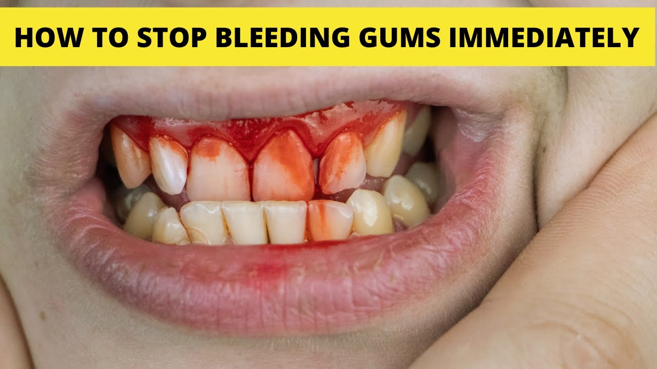 How To Stop Gum Bleeding Immediately Home Remedy