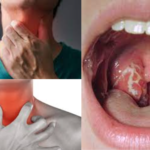 How To Cure A Sore Throat Fast