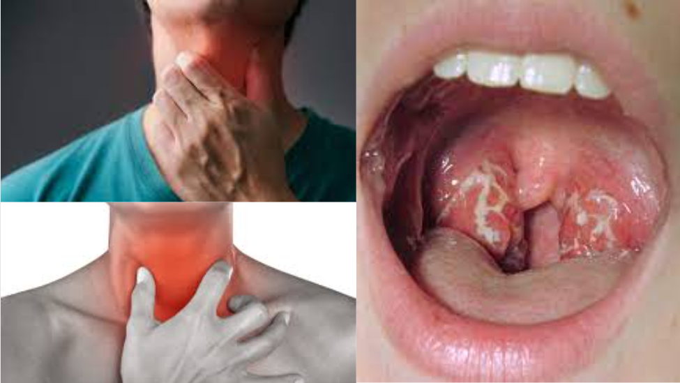 How To Cure A Sore Throat Fast