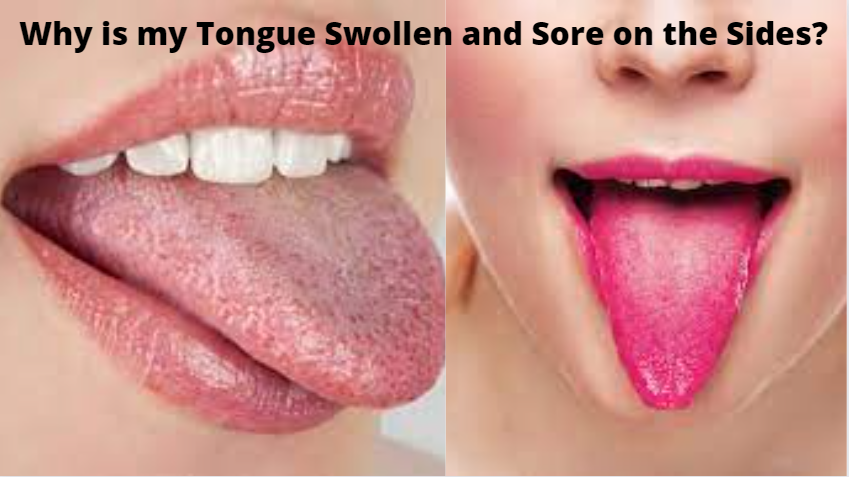 Why Is My Tongue Swollen And Sore On The Sides