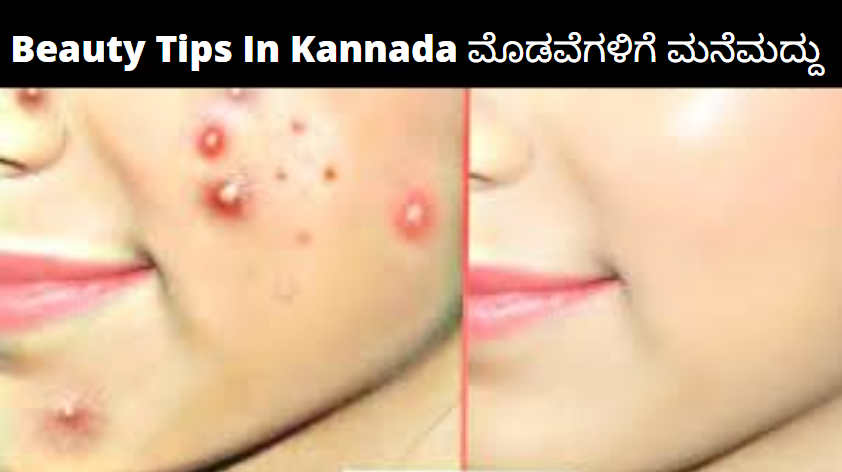 Beauty Tips Kannadadalli | ಮೊಡವೆ ನಿವಾರಣೆಗೆ ಮನೆ ಮದ್ದುಗಳು