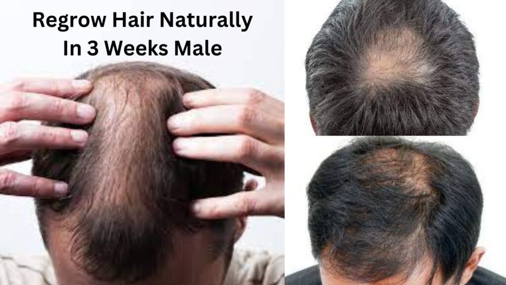 Regrow Hair Naturally In 3 Weeks Male