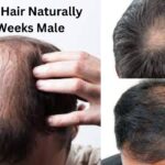Regrow Hair Naturally In 3 Weeks Male