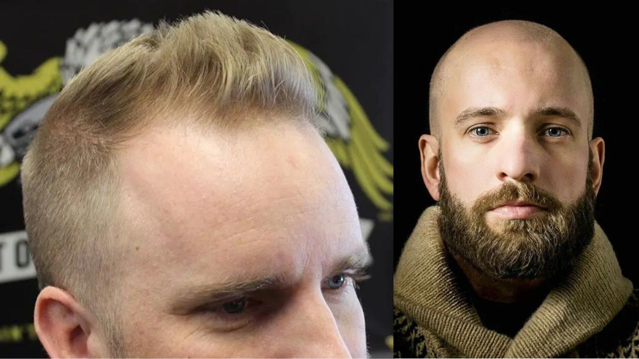 30+Male Pattern Baldness Hairstyle For Thin Hair Male