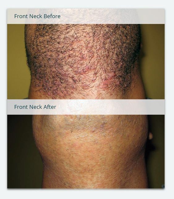 Full Brazilian Laser Hair Removal Before And After Photos