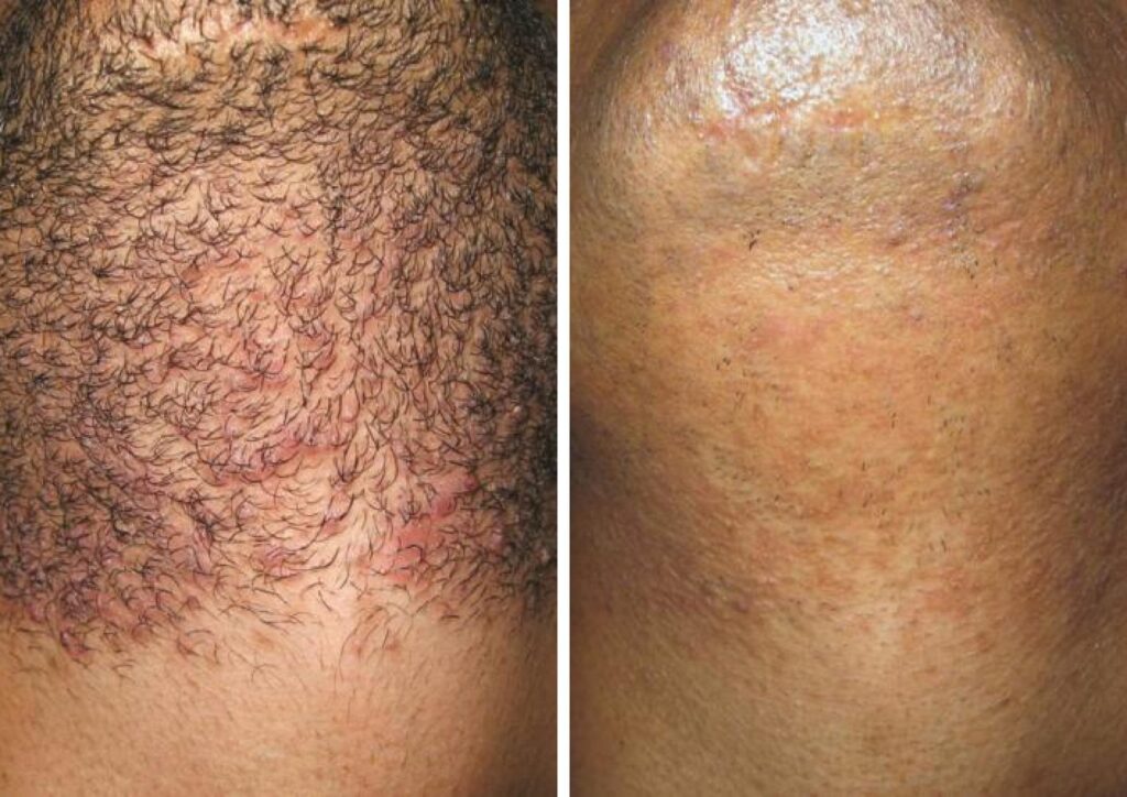 Laser Hair Removal Nelson | Mabin House Body & Skin Sanctuary