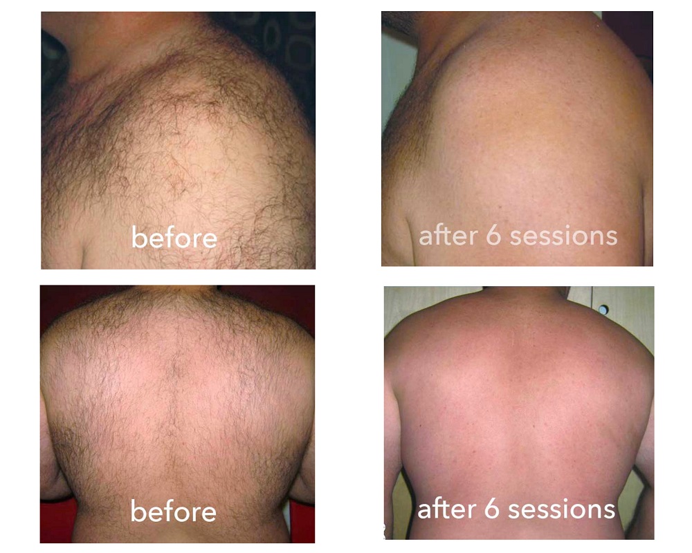 Full Brazilian Laser Hair Removal Before And After Photos