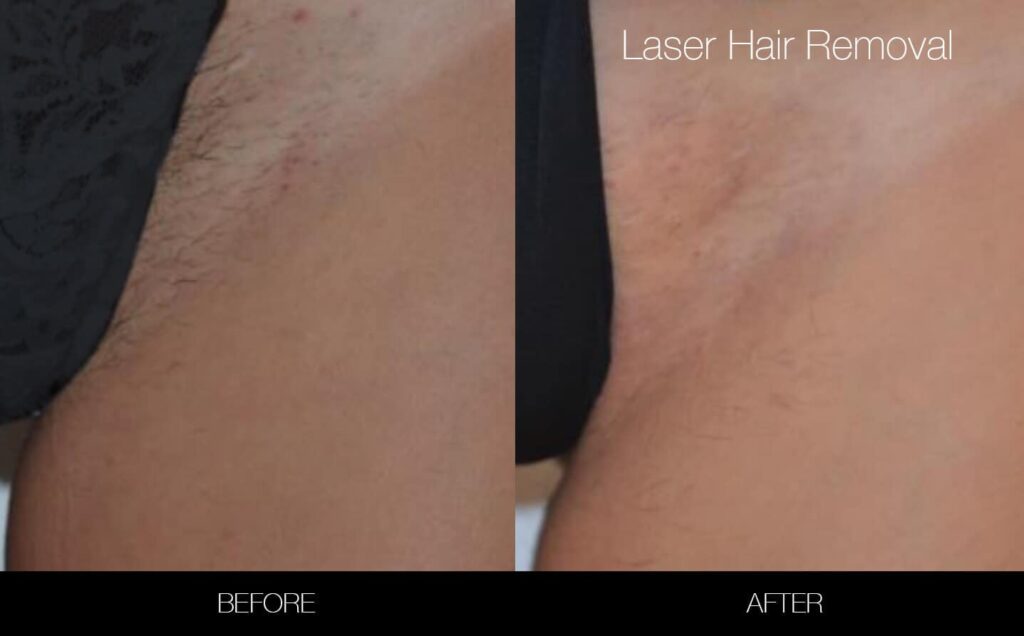 Full Brazilian Laser Hair Removal Before And After Photos