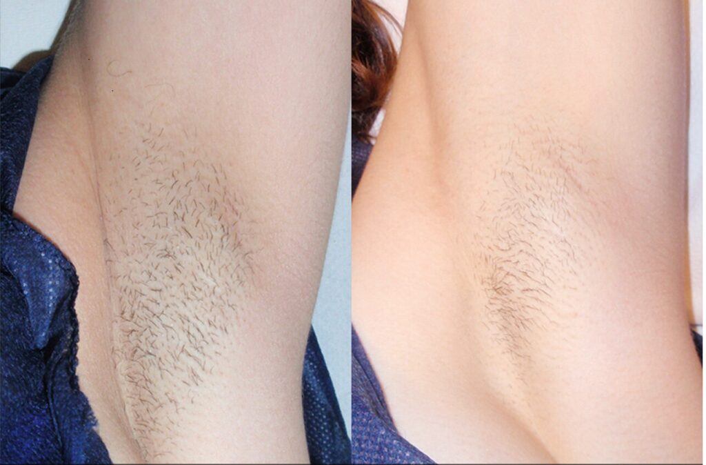 Full Brazilian Laser Hair Removal Before And After Photos