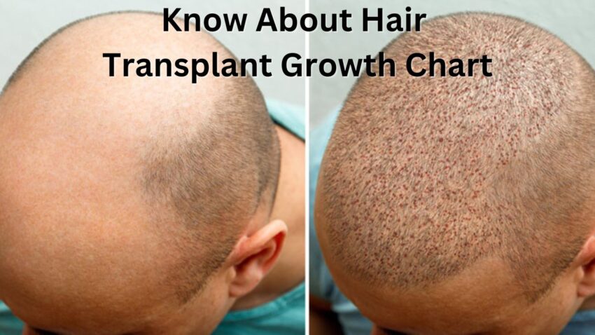 Know About Hair Transplant Growth Chart